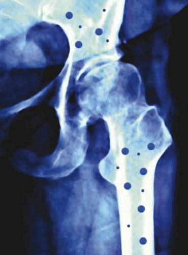 Osteoporosia